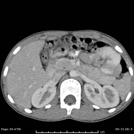 Agenesis of the gallbladder (Radiopaedia 55454-61905 B 34).jpg