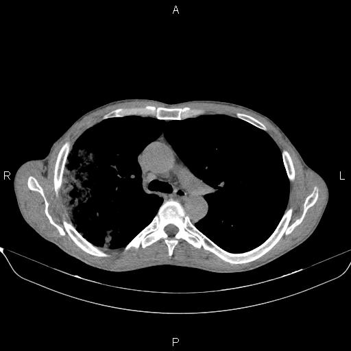 File:Air bronchogram in pneumonia (Radiopaedia 85719-101512 Axial non-contrast 26).jpg