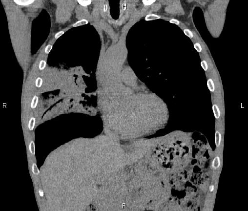 Air bronchogram in pneumonia (Radiopaedia 85719-101512 Coronal non-contrast 22).jpg