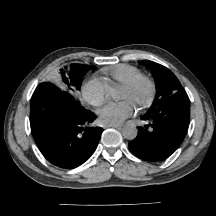 Airway foreign body in adult (Radiopaedia 85907-101779 Axial liver window 114).jpg