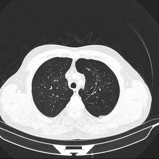 File:Allergic bronchopulmonary aspergillosis (Radiopaedia 21386-21320 Axial lung window 8).jpg