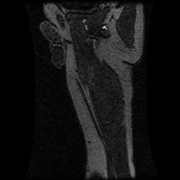 Alveolar soft part sarcoma (Radiopaedia 64501-73678 D 25).jpg