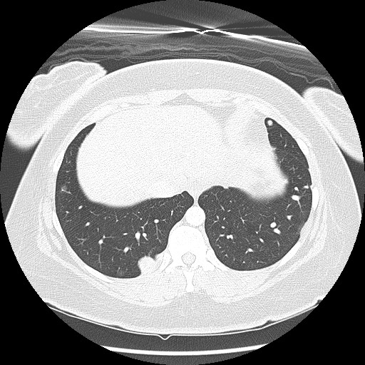 Alveolar soft part sarcoma - right leg (Radiopaedia 59432-67091 Axial lung window 91).jpg