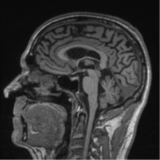 Alzheimer's disease- with Gerstmann syndrome and dressing apraxia (Radiopaedia 54882-61150 Sagittal T1 37).png