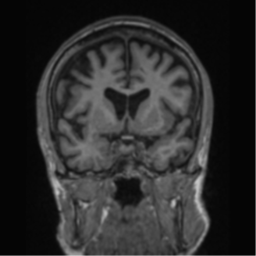 File:Alzheimer's disease- with apraxia (Radiopaedia 54763-61011 Coronal T1 59).png