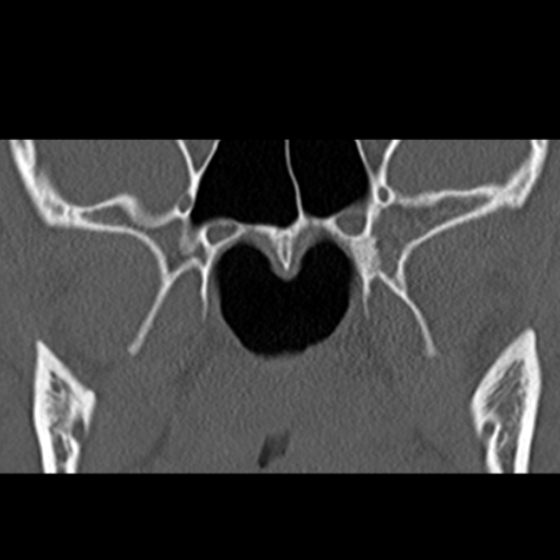 File:Ameloblastic fibro-odontoma (Radiopaedia 18843-18780 B 23).jpg
