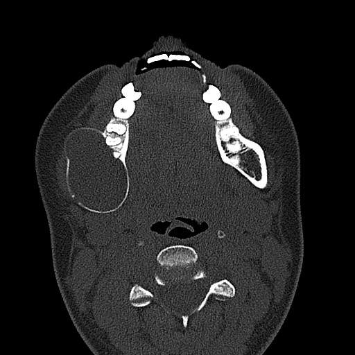 File:Ameloblastoma (Radiopaedia 26645-26793 E 35).jpg