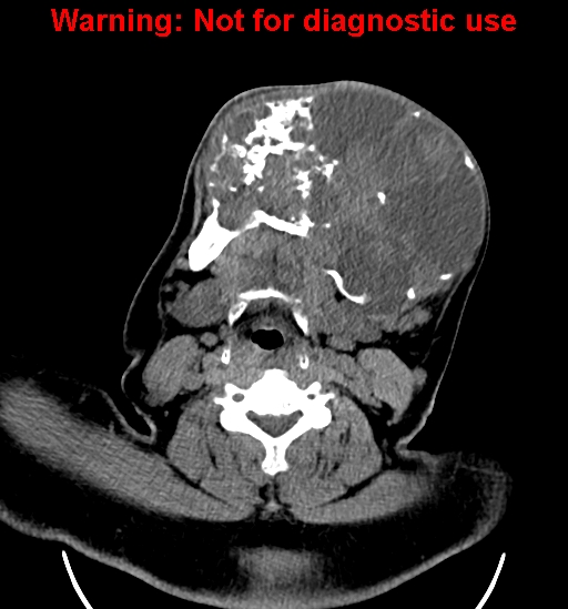 File:Ameloblastoma (Radiopaedia 33126-34164 A 17).jpg