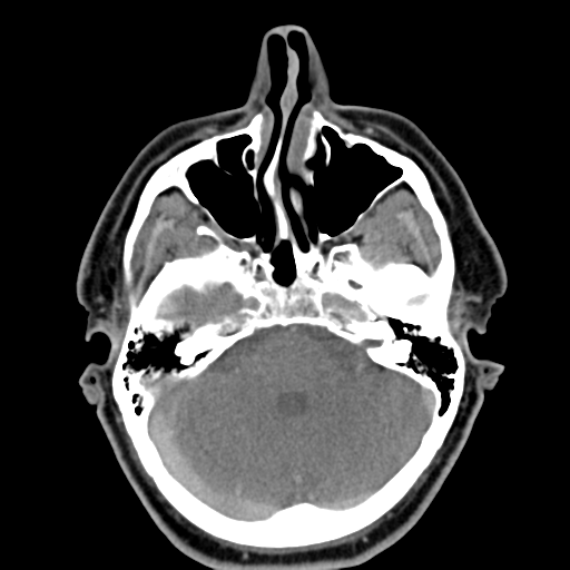 Ameloblastoma (Radiopaedia 38520-40623 Axial non-contrast 11).png