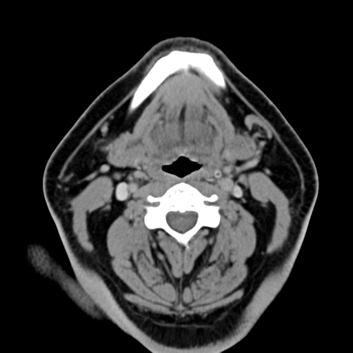 Ameloblastoma (Radiopaedia 38520-40623 Axial non-contrast 38).png