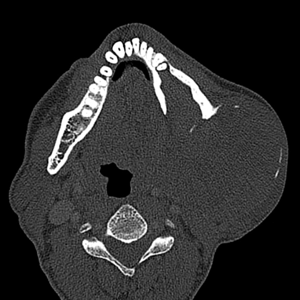 Ameloblastoma (Radiopaedia 51921-57766 Axial bone window 64).jpg
