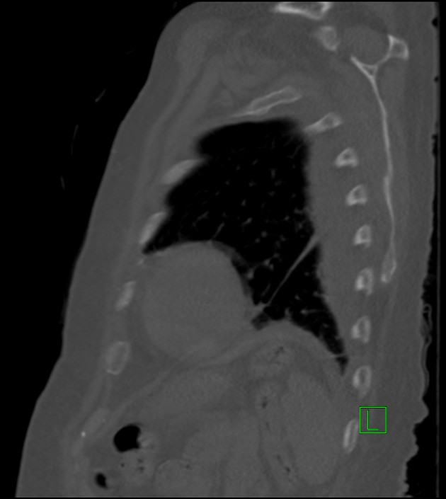 Amiodarone deposition in the liver (Radiopaedia 77587-89780 Sagittal bone window 23).jpg