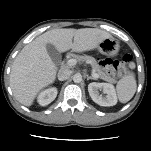 Amoebic liver abscesses (Radiopaedia 55536-62009 A 31).jpg