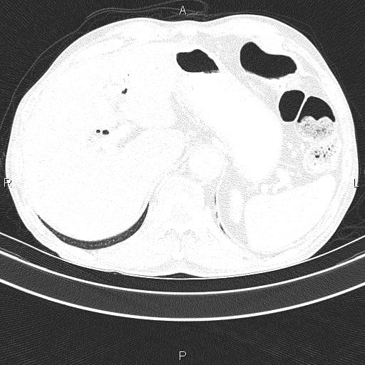 Ampullary adenocarcinoma (Radiopaedia 86093-102033 Axial lung window 53).jpg