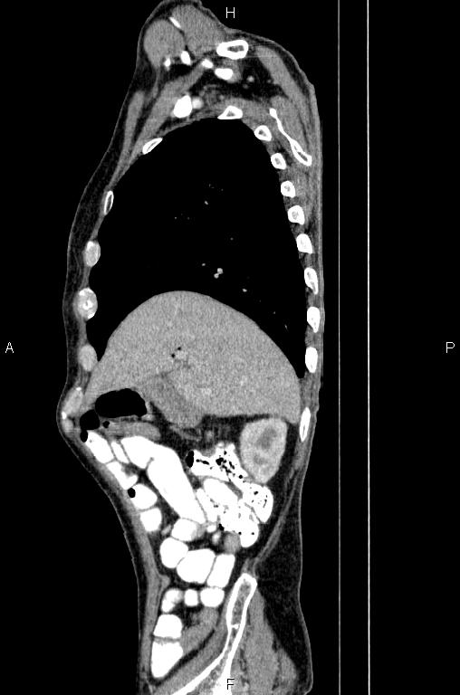 Ampullary adenocarcinoma (Radiopaedia 86093-102033 E 19).jpg