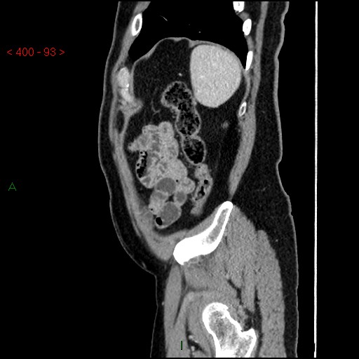 Ampullary carcinoma (Radiopaedia 56396-63056 D 92).jpg