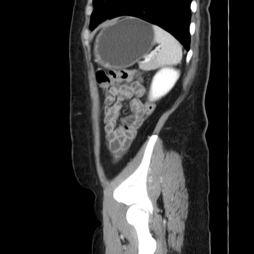 Ampullary tumor (Radiopaedia 22787-22816 D 45).jpg