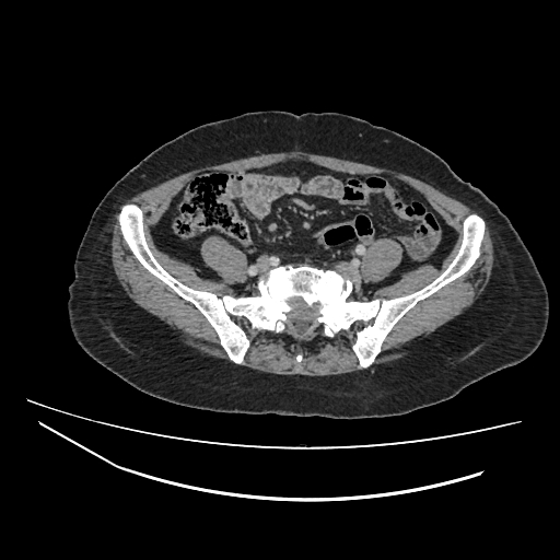 File:Ampullary tumor (Radiopaedia 60333-67998 A 64).jpg