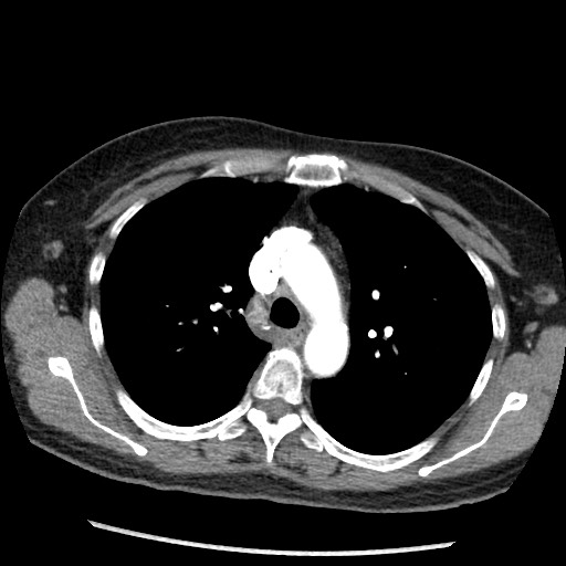 File:Amyloidosis - bronchial and diffuse nodular pulmonary involvement (Radiopaedia 60156-67745 A 17).jpg