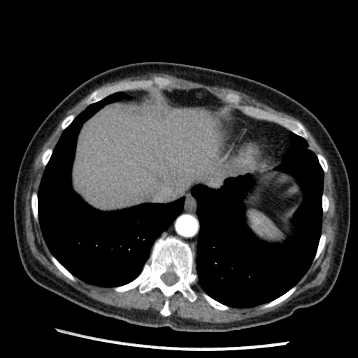 Amyloidosis - bronchial and diffuse nodular pulmonary involvement (Radiopaedia 60156-67745 A 44).jpg