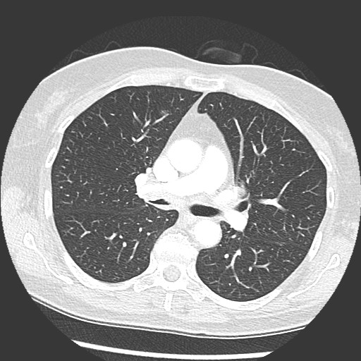 Amyloidosis - bronchial and diffuse nodular pulmonary involvement (Radiopaedia 60156-67745 Axial lung window 34).jpg