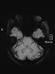 File:Amyotrophic lateral sclerosis (Radiopaedia 70821-81017 Axial SWI minIP 8).jpg