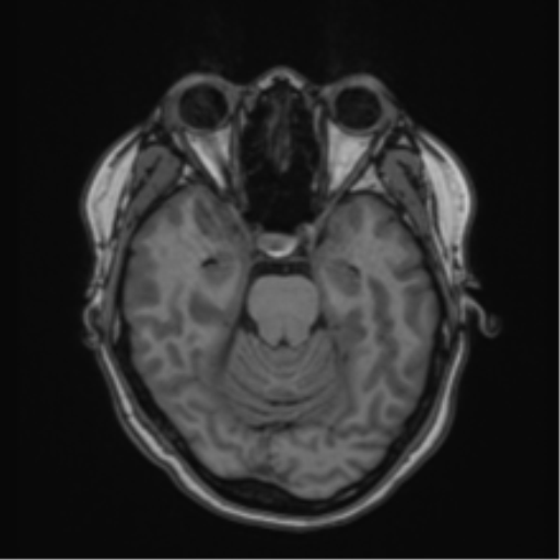 Anaplastic astroblastoma (Radiopaedia 55666-62194 Axial T1 26).png