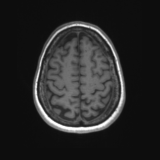 File:Anaplastic astrocytoma - thalamic glioma (Radiopaedia 59709-67115 Axial T1 35).png
