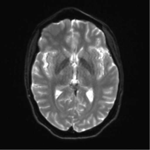 File:Anaplastic astrocytoma IDH mutant (Radiopaedia 50046-55341 Axial DWI 14).png