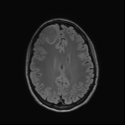 File:Anaplastic astrocytoma IDH mutant (Radiopaedia 50046-55341 Axial FLAIR 33).png