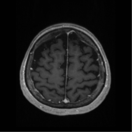 File:Anaplastic astrocytoma IDH wild-type (pseudoprogression) (Radiopaedia 42209-45276 Axial T1 C+ 118).png