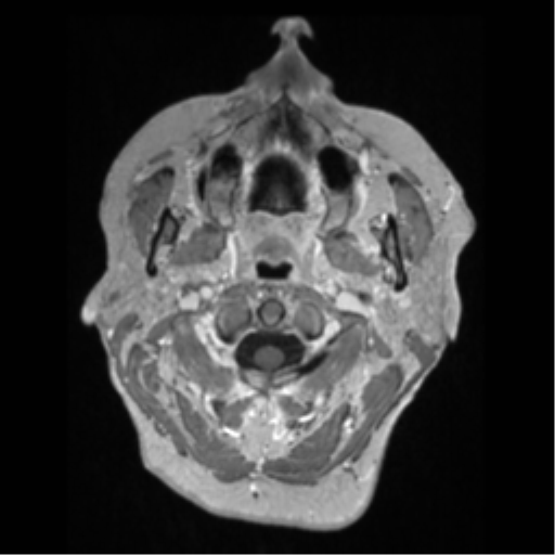 Anaplastic astrocytoma IDH wild-type (pseudoprogression) (Radiopaedia 42209-45276 Axial T1 C+ 5).png