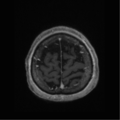 Anaplastic astrocytoma IDH wild-type (pseudoprogression) (Radiopaedia 42209-45277 Axial T1 C+ 113).png