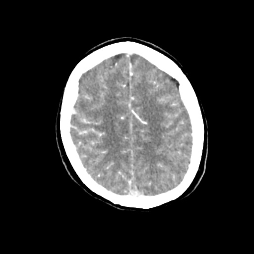 Aneursym related subarachnoid hemorrhage with hydrocephalus (Radiopaedia 45105-49084 D 41).jpg
