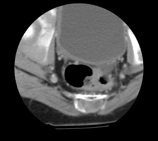 File:Aneurysmal bone cyst - sacrum (Radiopaedia 65190-74195 Axial non-contrast 40).jpg