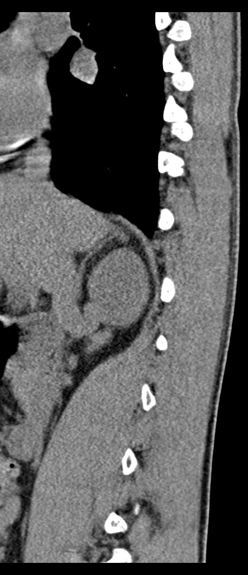Aneurysmal bone cyst T11 (Radiopaedia 29294-29721 E 61).jpg