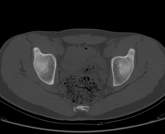 File:Aneurysmal bone cyst of ischium (Radiopaedia 25957-26094 Axial bone window 49).png