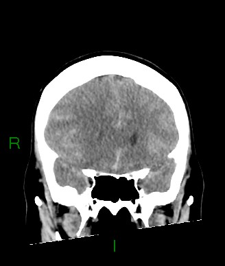 Aneurysmal subarachnoid hemorrhage with intra-axial extension (Radiopaedia 84371-99699 Coronal non-contrast 46).jpg