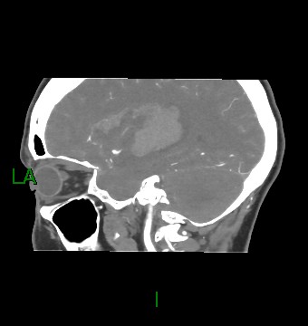 Aneurysmal subarachnoid hemorrhage with intra-axial extension (Radiopaedia 84371-99732 B 48).jpg