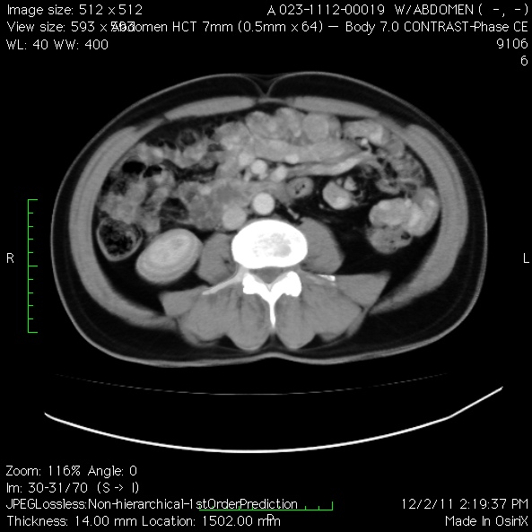 File:Angiodysplasia of the small bowel (Radiopaedia 16387-16075 C 1).jpg