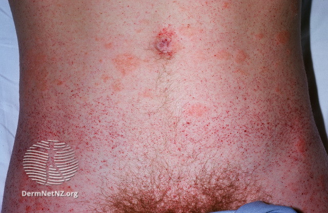 File:Angiokeratomas in Fabry disease (DermNet NZ angiokeratoma-14).jpg
