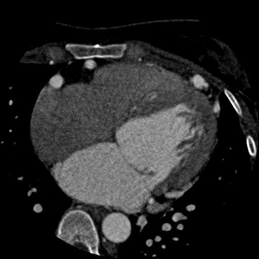 Anomalous left coronary artery from the pulmonary artery (ALCAPA) (Radiopaedia 40884-43586 A 43).jpg