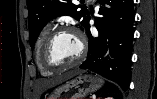File:Anomalous left coronary artery from the pulmonary artery (ALCAPA) (Radiopaedia 70148-80181 C 184).jpg