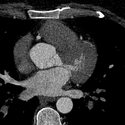 File:Anomalous origin of the left coronary artery with malignant course (Radiopaedia 77842-90126 C 86).jpeg