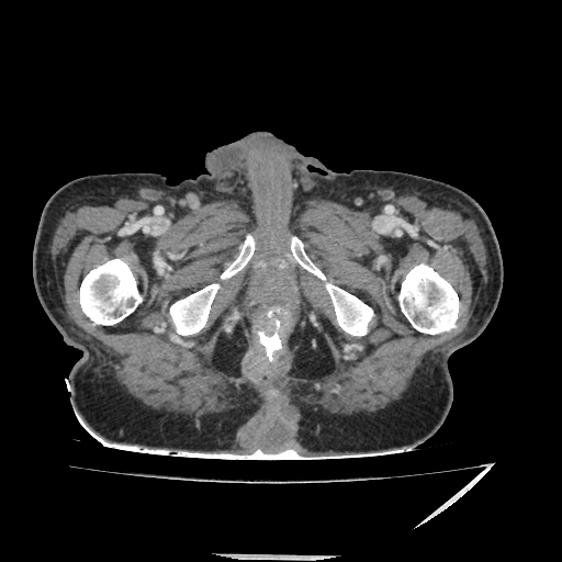 Anorectal carcinoma (Radiopaedia 44413-48064 A 58).jpg