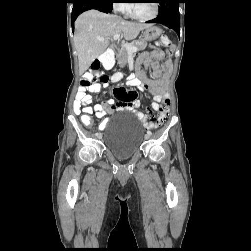 Anorectal carcinoma (Radiopaedia 44413-48064 B 25).jpg