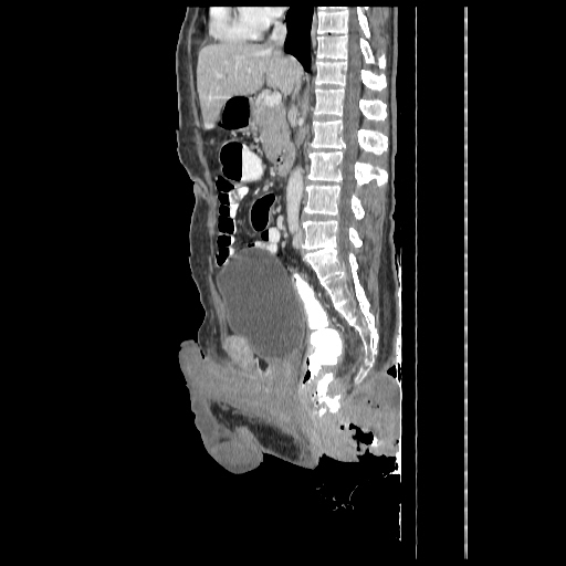 Anorectal carcinoma (Radiopaedia 44413-48064 C 53).jpg
