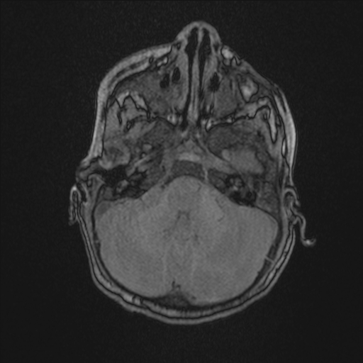 Anoxic brain injury (Radiopaedia 79165-92139 Axial MRA 50).jpg
