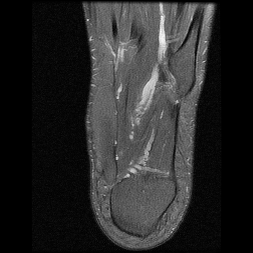 File:Anterior calcaneal process fracture (Radiopaedia 74654-85611 Axial PD fat sat 26).jpg