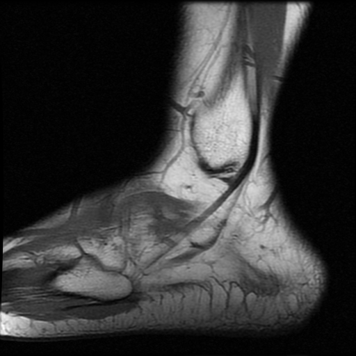File:Anterior calcaneal process fracture (Radiopaedia 74654-85611 Sagittal T1 19).jpg